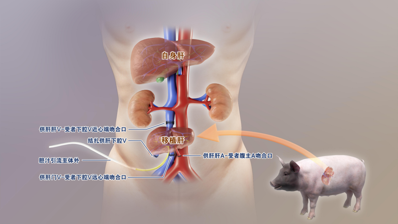 △基因编辑猪肝植入人体突破跨物种器官移植壁垒